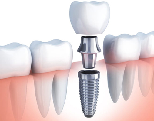 Wakankar Dental