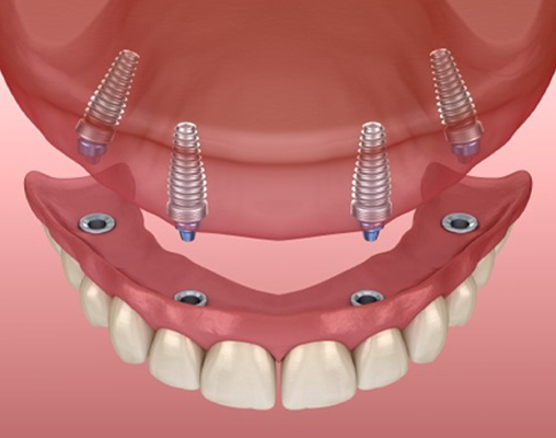 Wakankar Dental