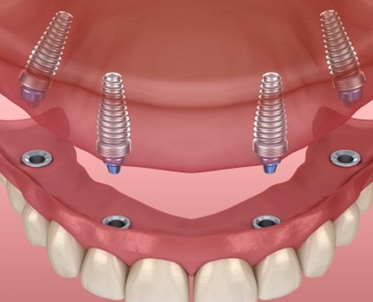 Wakankar Dental