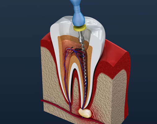 Wakankar Dental